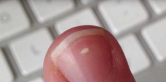 指甲上的白點代表什麼?